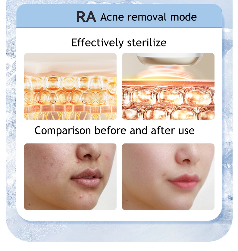 3-in-1 Replaceable Head Ice Hair Removal Device Full-Body Use for Lips Underarms and Private Area