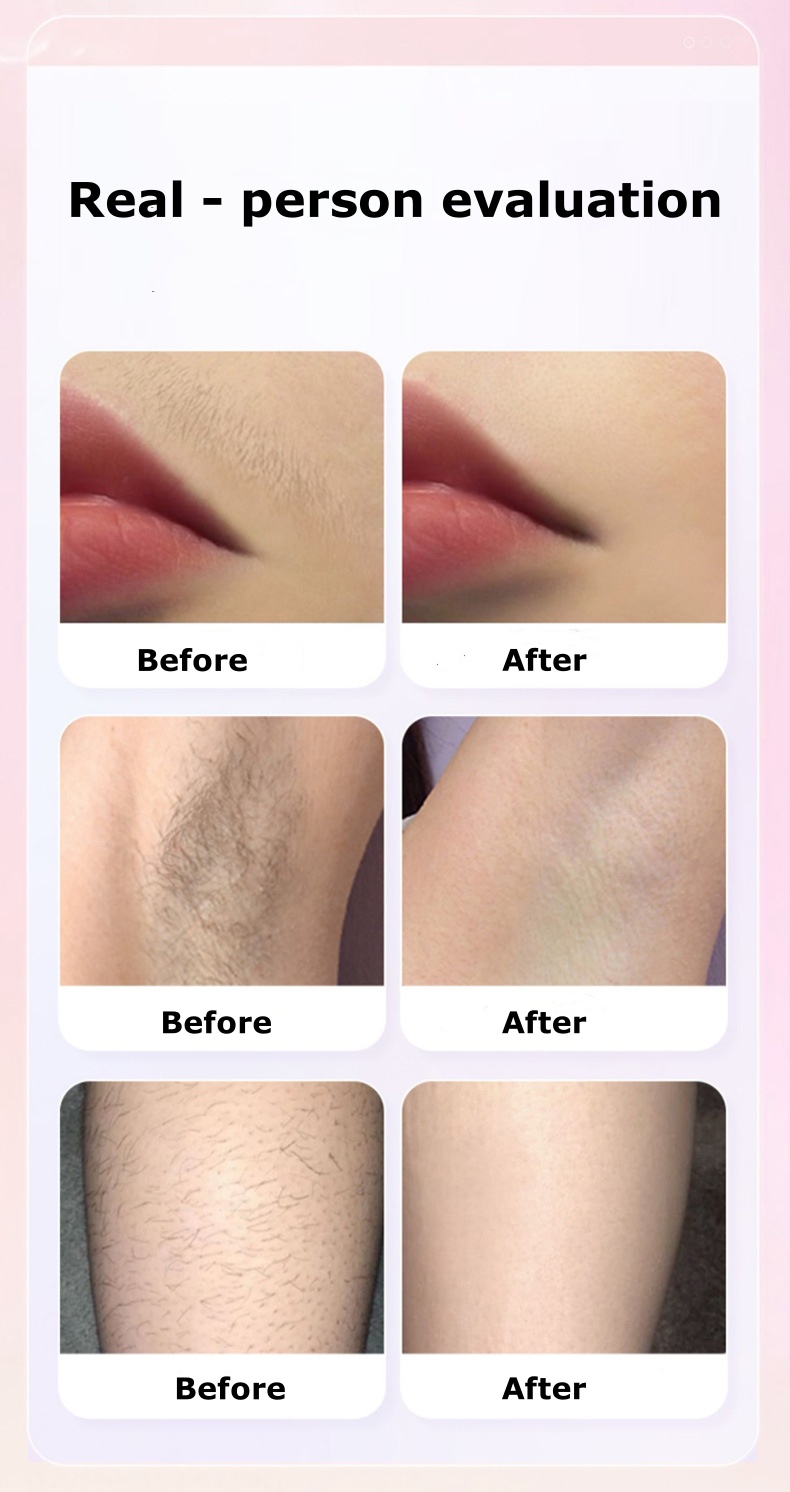 IPL Ice Point Laser Hair Removal Device for Home Use – Painless Electric Hair Remover